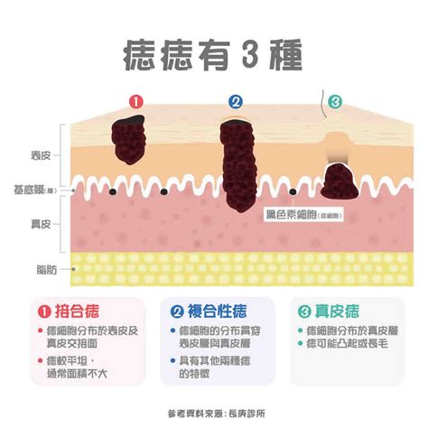 身上痣多|痣形成的原因？痣長毛、痣變多變大是痣病變？5招判別